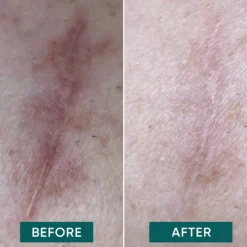 Apricot Scar Pads