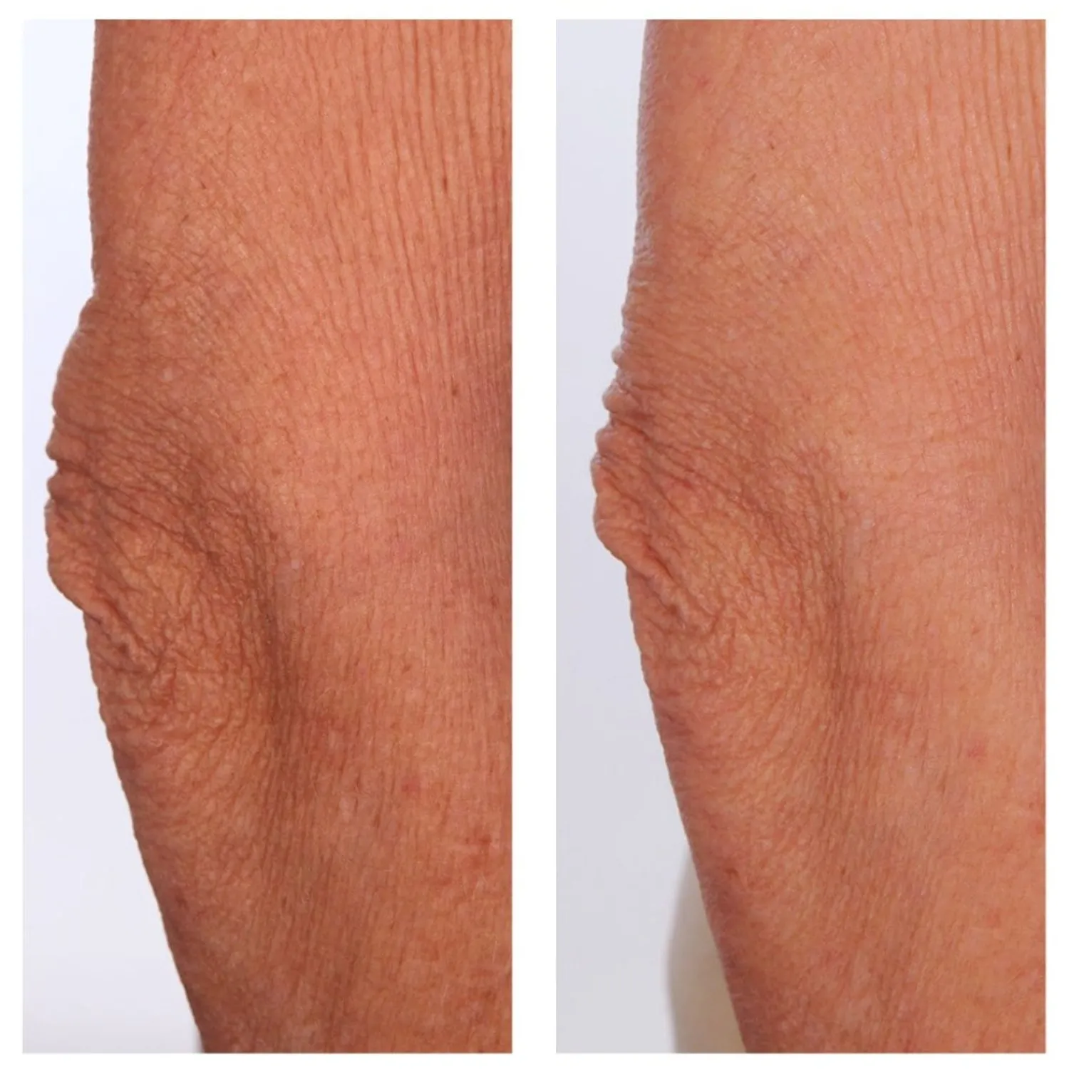 U BEAUTY Beauty The Sculpt Arm-Compound