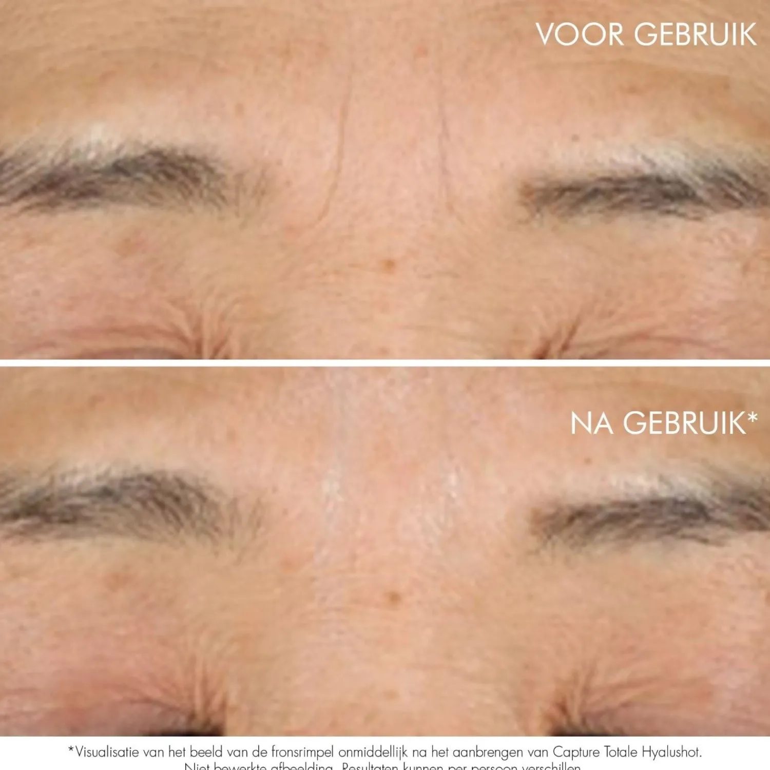 DIOR Leg Totale Hyalushot Vast